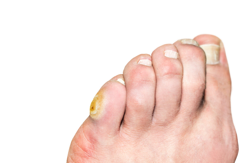 How To Get Rid Of Corn On Pinky Toe