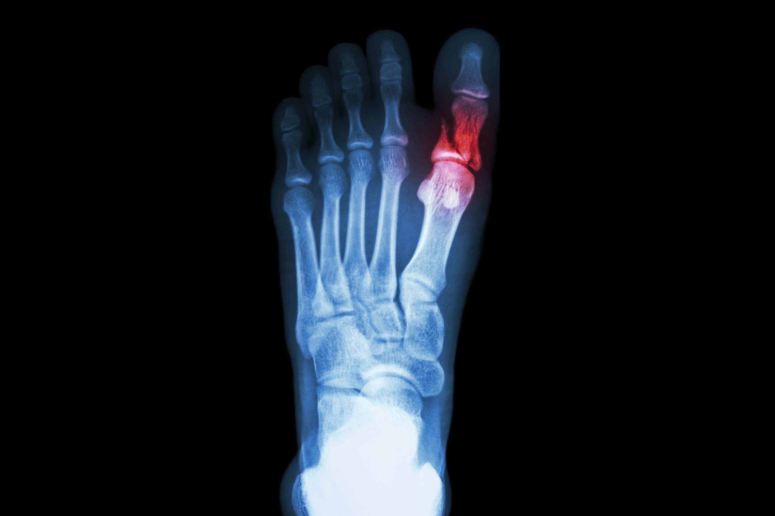 Fractured Toes Causes And Treatment Canyon Oaks Visalia Podaitrist