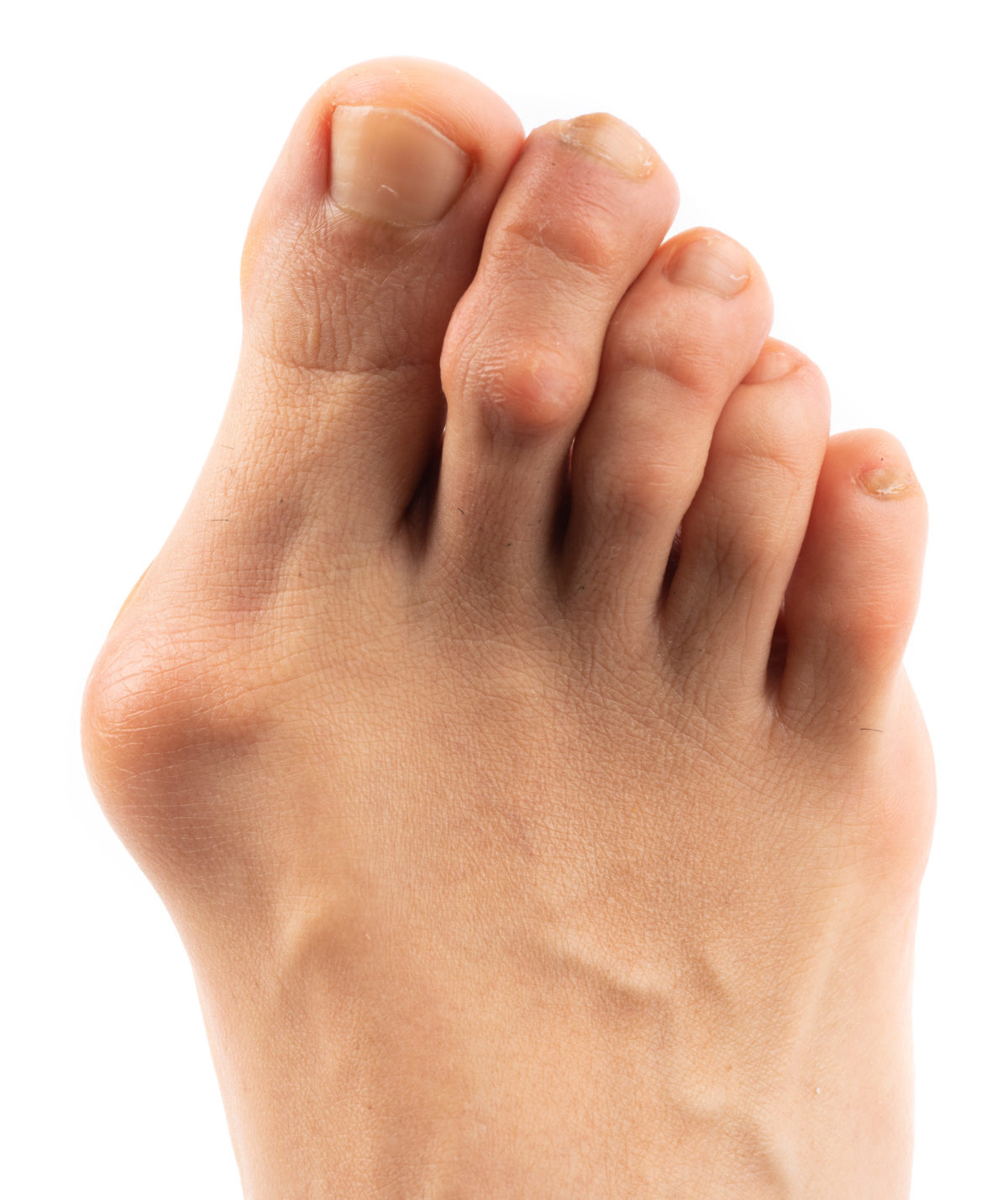Bunions Causes, Types, and Treatments Canyon Oaks Foot & Ankle