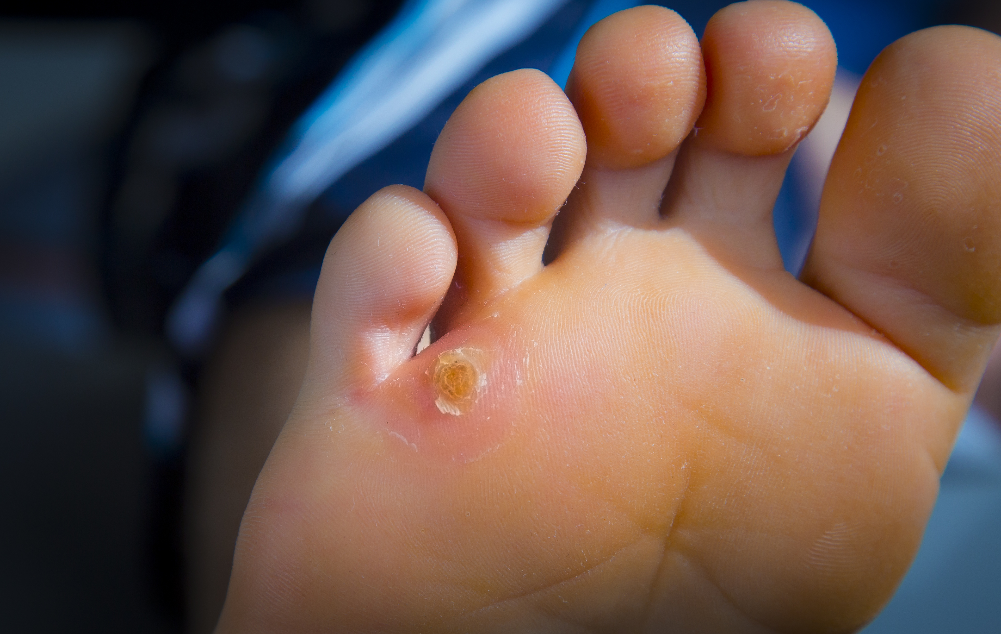 Why You Should Never DIY Corn And Callus Removal