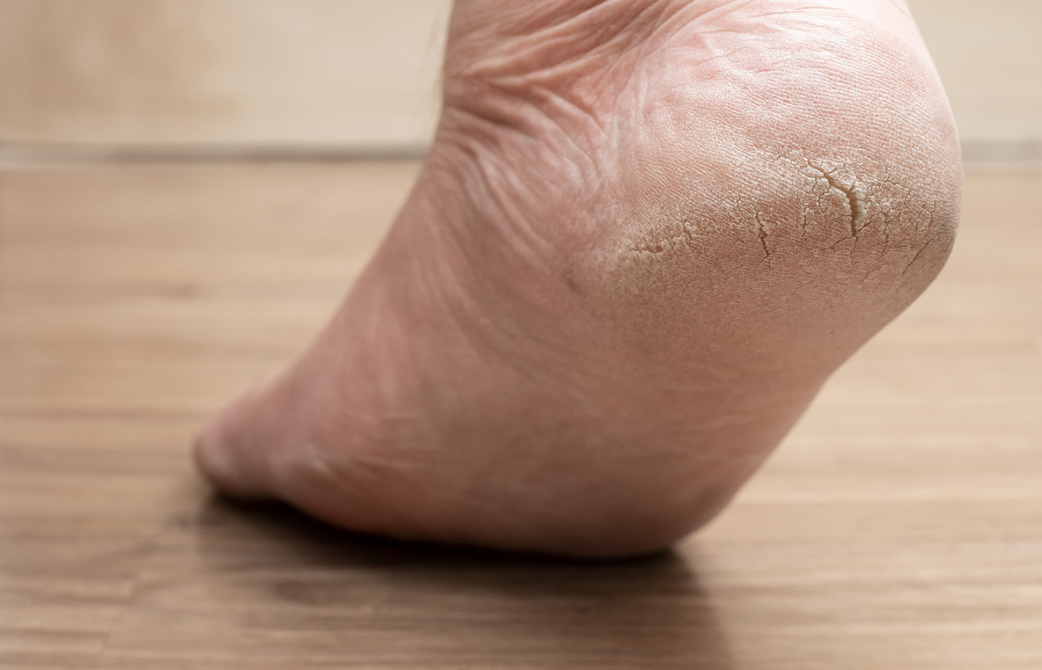 Cracked Skin Peeling Foot Crack Heel Crack Peeling Removal Dead Skin Salon  Step | eBay