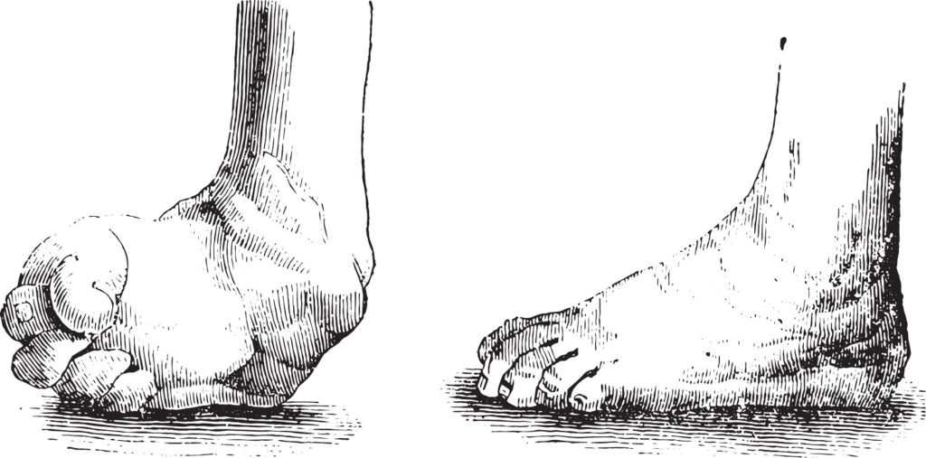 an image of a clubfoot