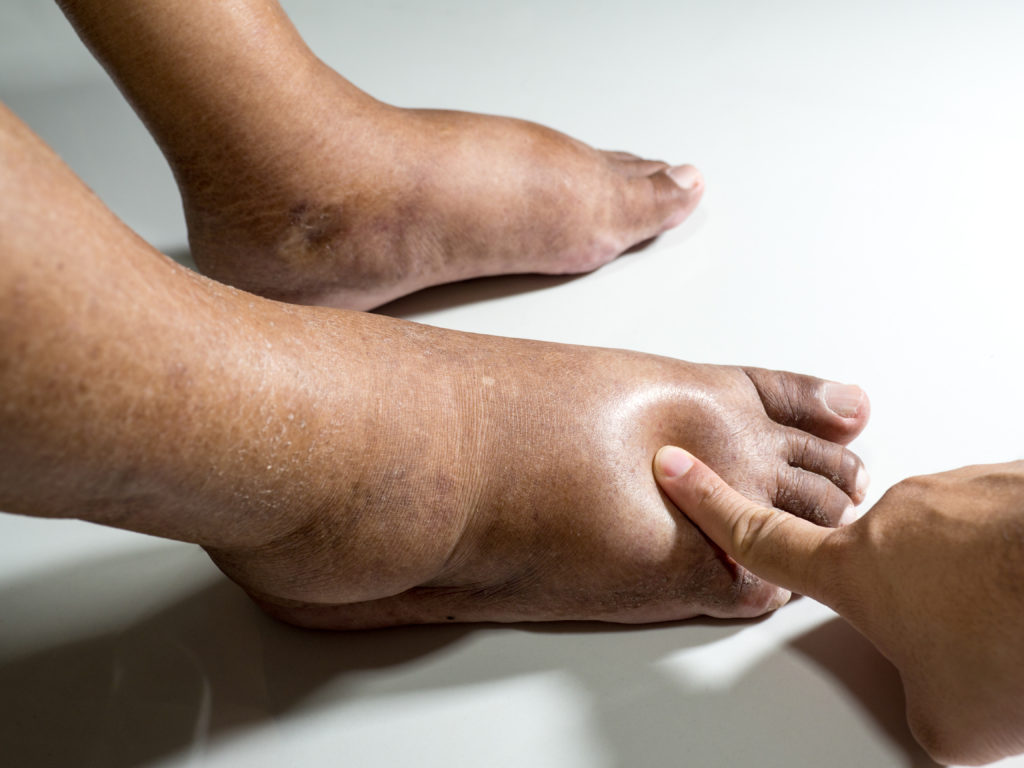 example of diabetic foot pain and a free diabetic wound care evaluation