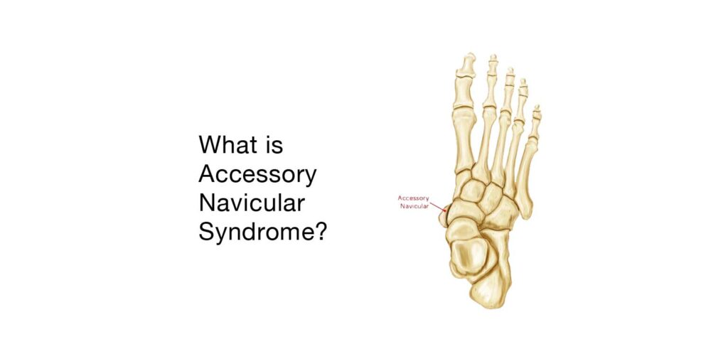 an example of Accessory Navicular Syndrome