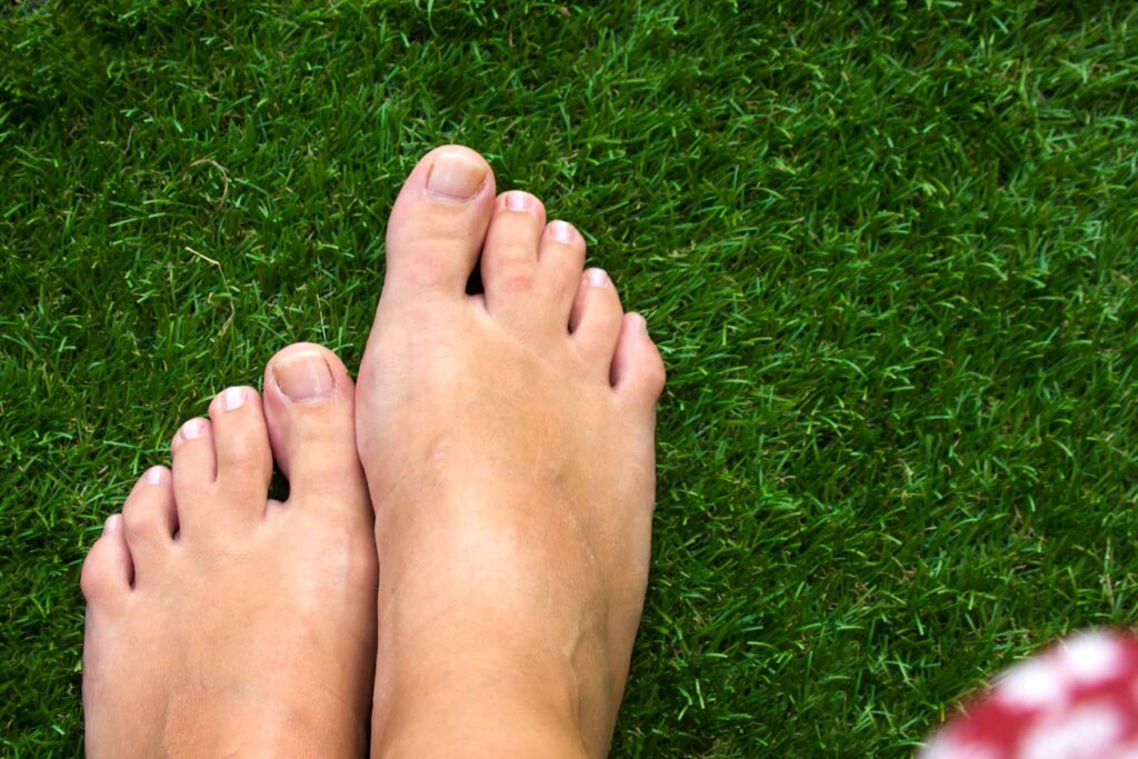 webbed-toes-causes-and-treatments-canyon-oaks-podiatrist-in-visalia