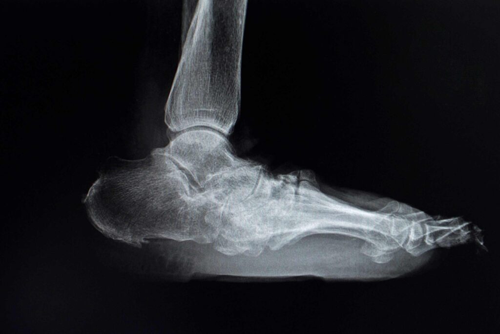 diabetic charcot foot image