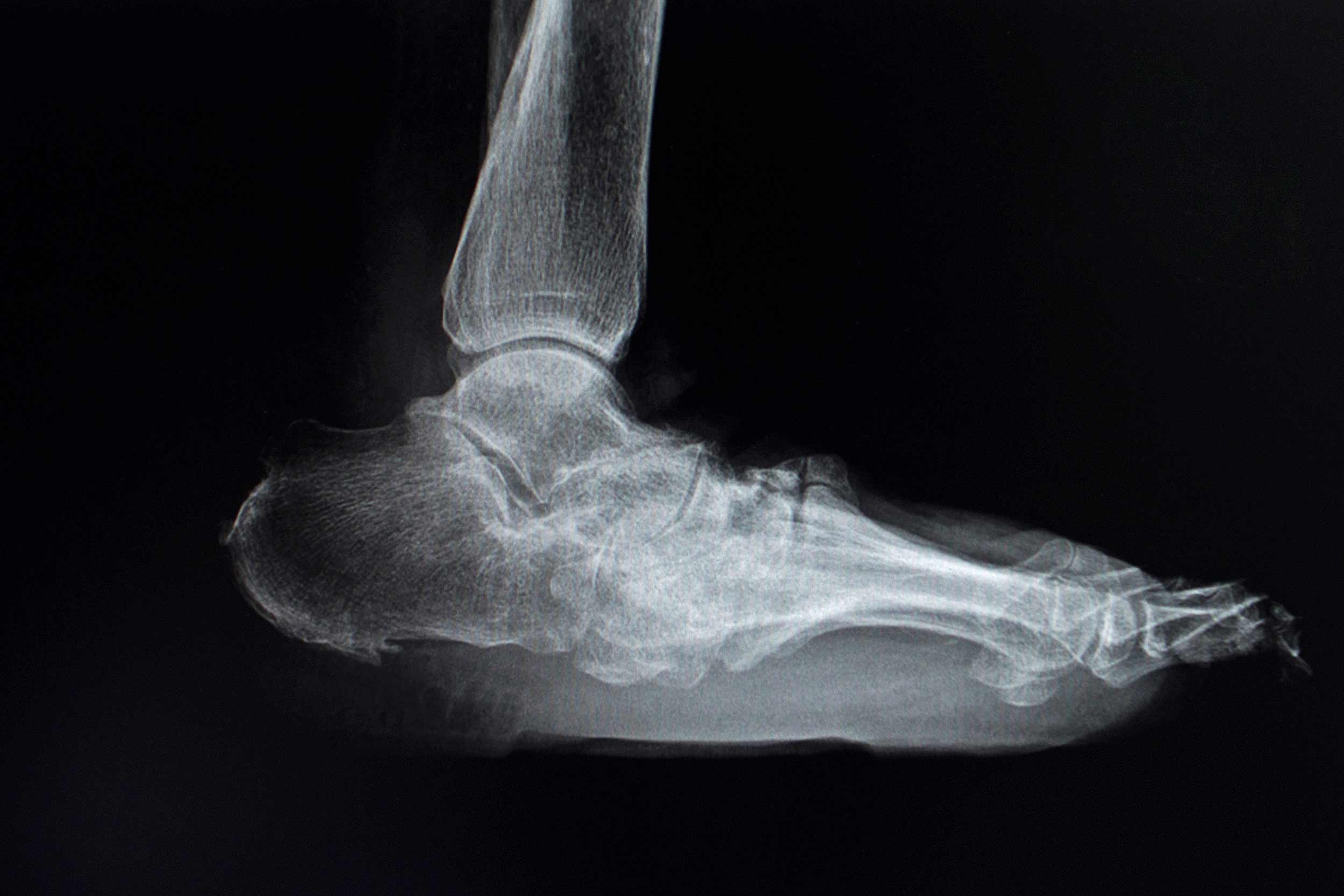 Diabetic Charcot Foot | Canyon Oaks Foot & Ankle | Fresno Podiatrist