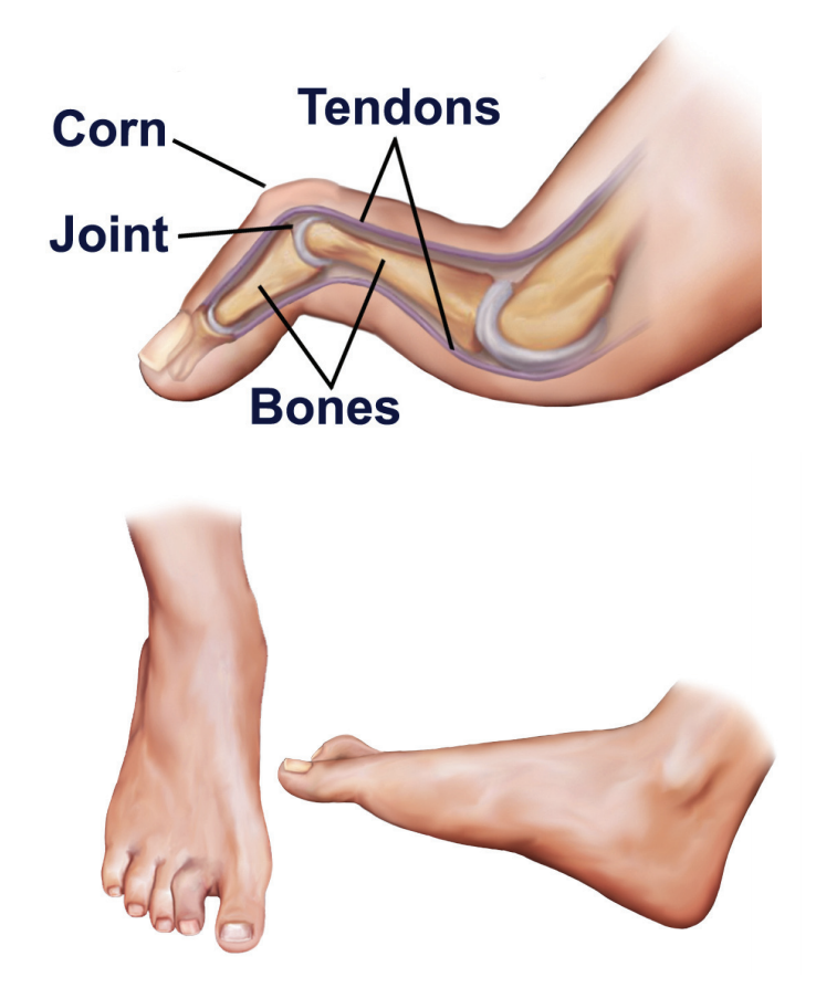 Hammertoe causes may be attributed to poorly fitted shoes