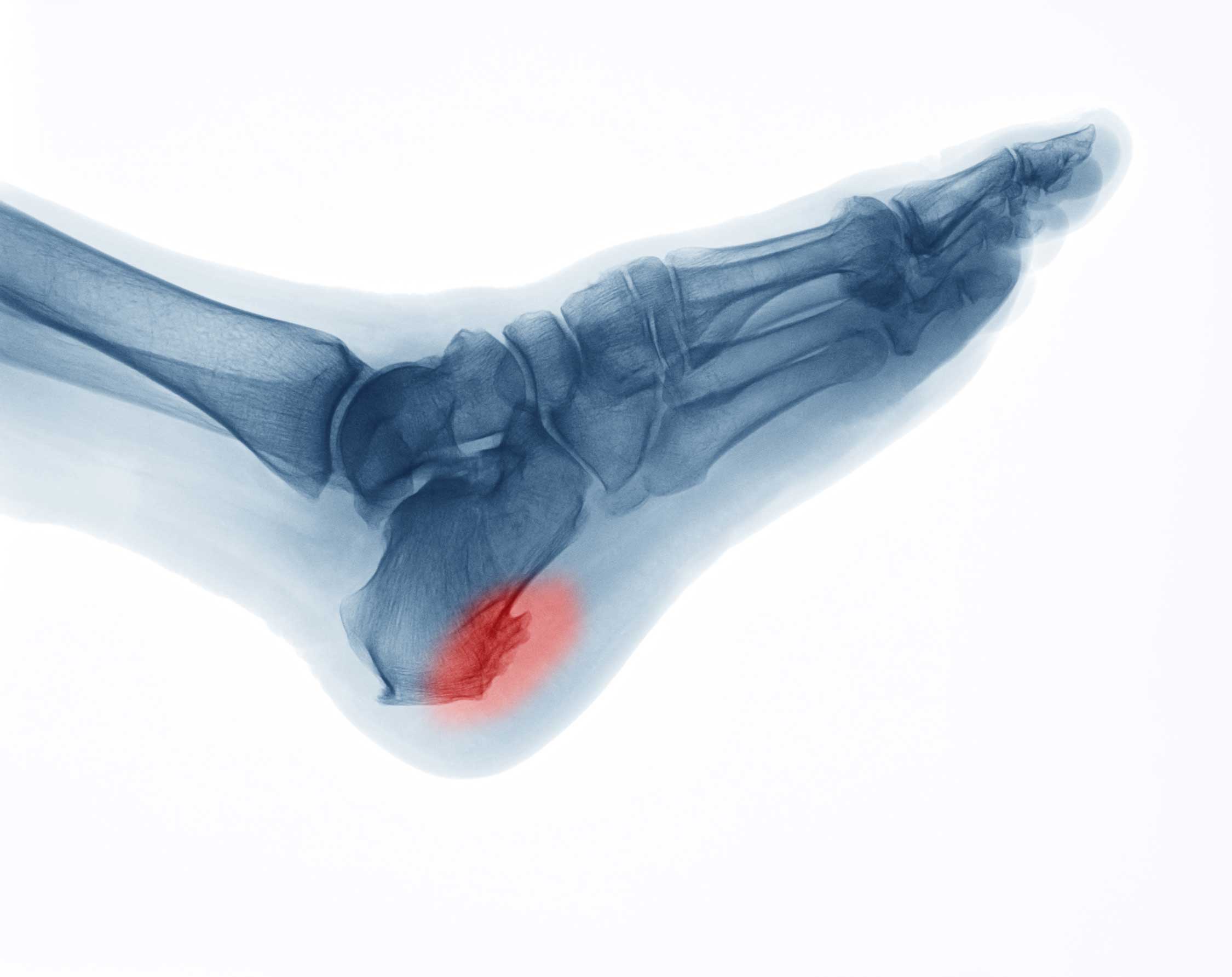 example of Outpatient Heel Spur Surgery protocol