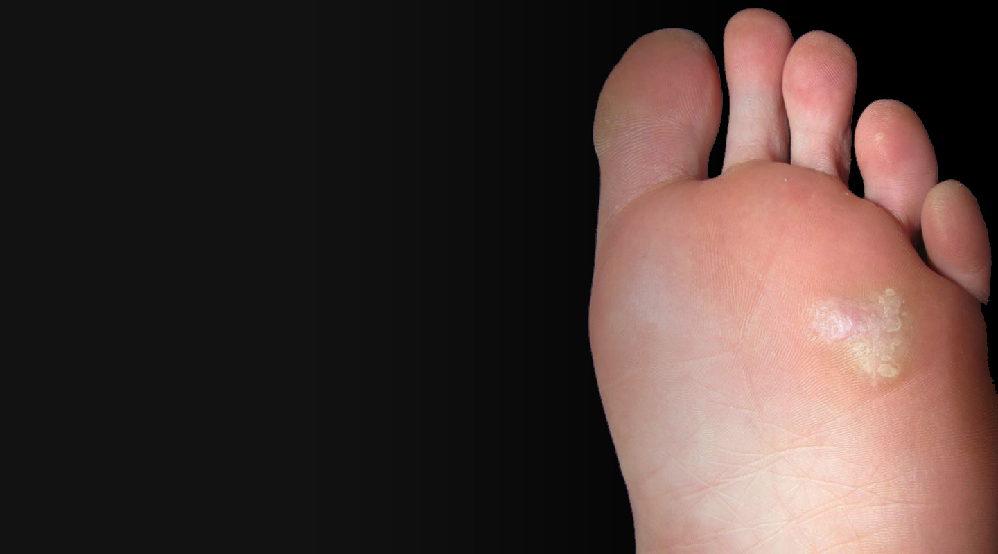 Canyon Oaks Doctors Treating Plantar Warts